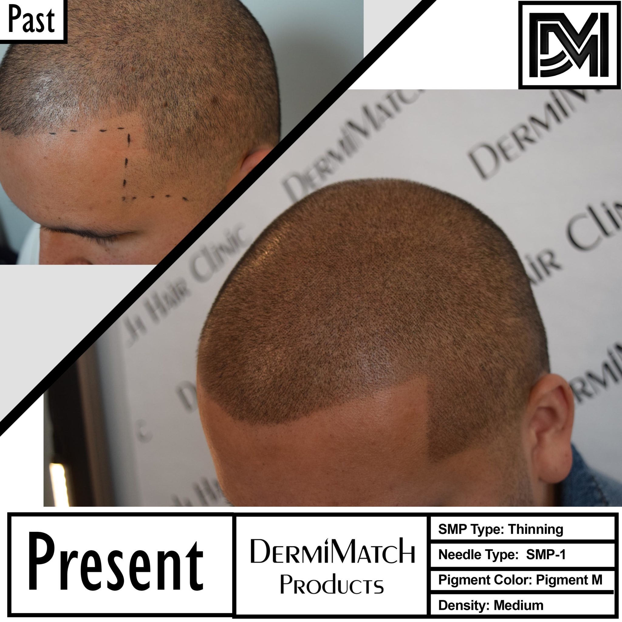 hair-loss-and-dry-scalp-dermimatch-hair-clinic-scalp