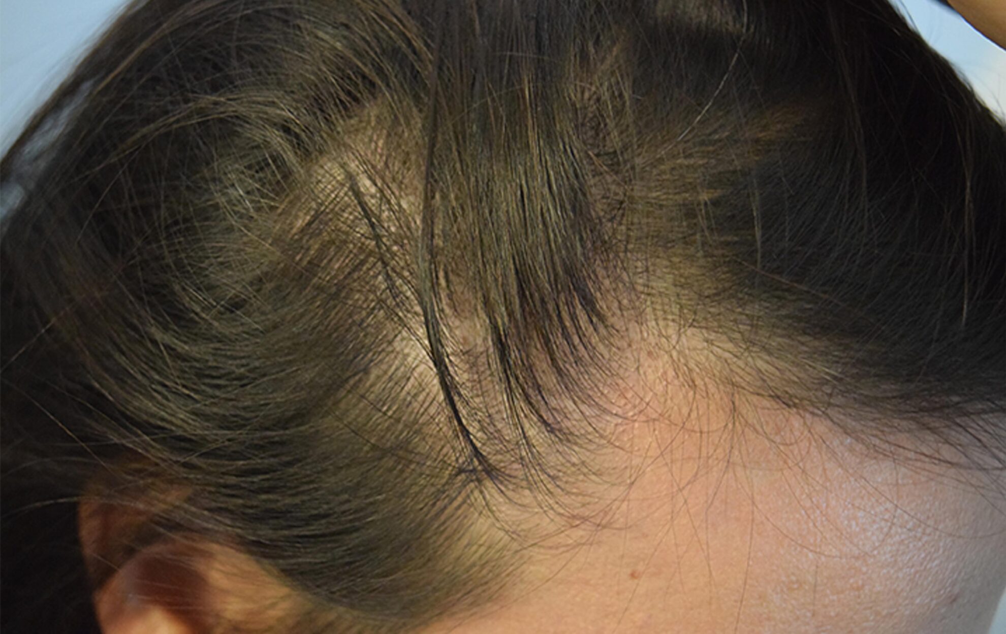 Vitamin Deficiency That Causes Hair Loss - DermiMatch Hair Clinic ...