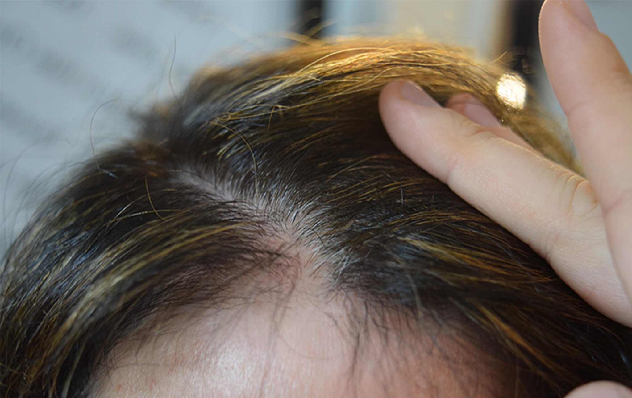 Understanding Causes of Thinning Hair in Women - DermiMatch Hair Clinic ...