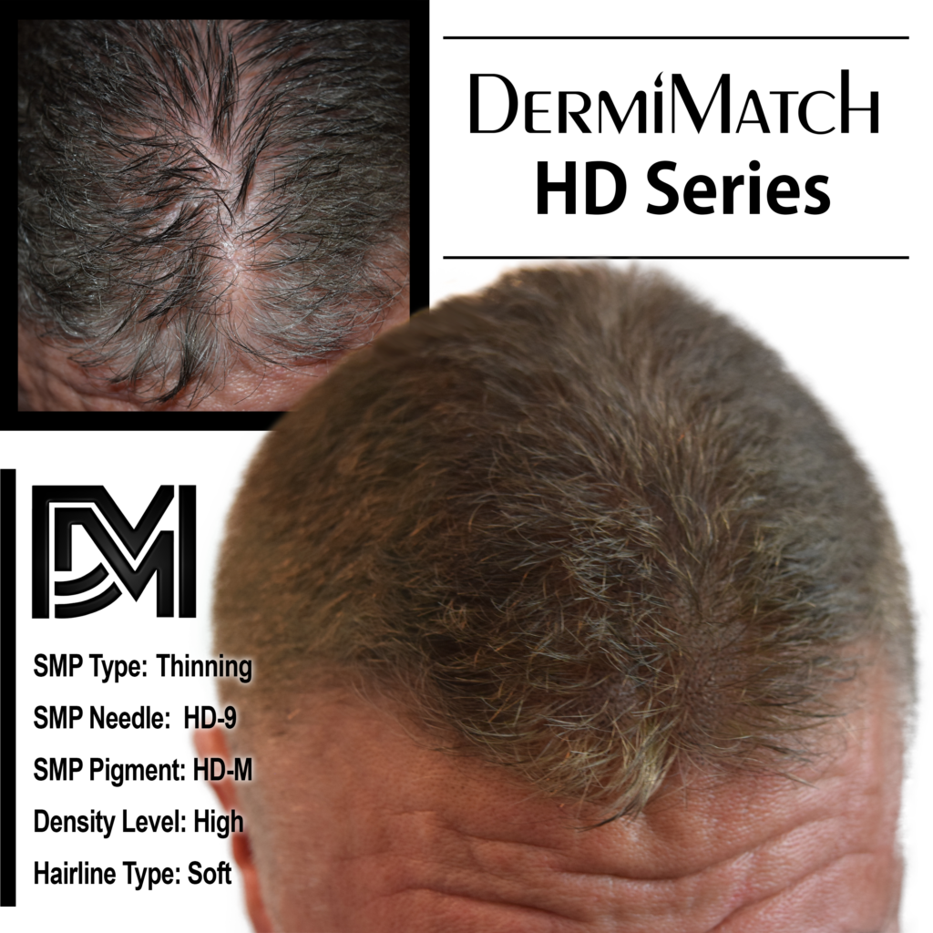 male-pattern-baldness-a-7-stage-journey-dermimatch-hair-clinic