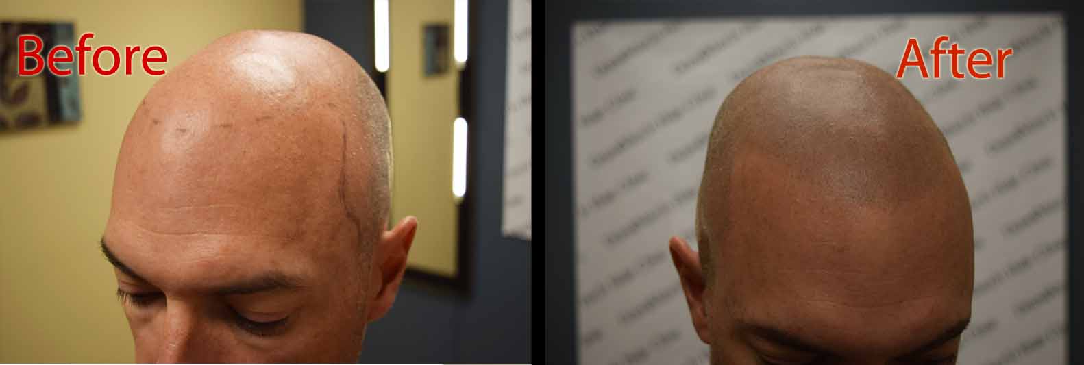 scalp micropigmentation smp for hair loss in arizona