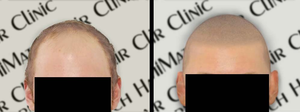 arizona scalp micropigmentation SMP