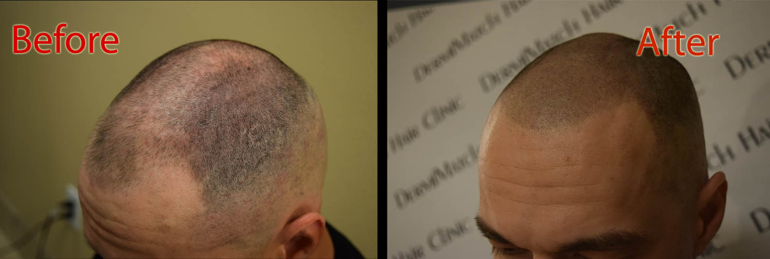 scalp micropigmentation smp arizona