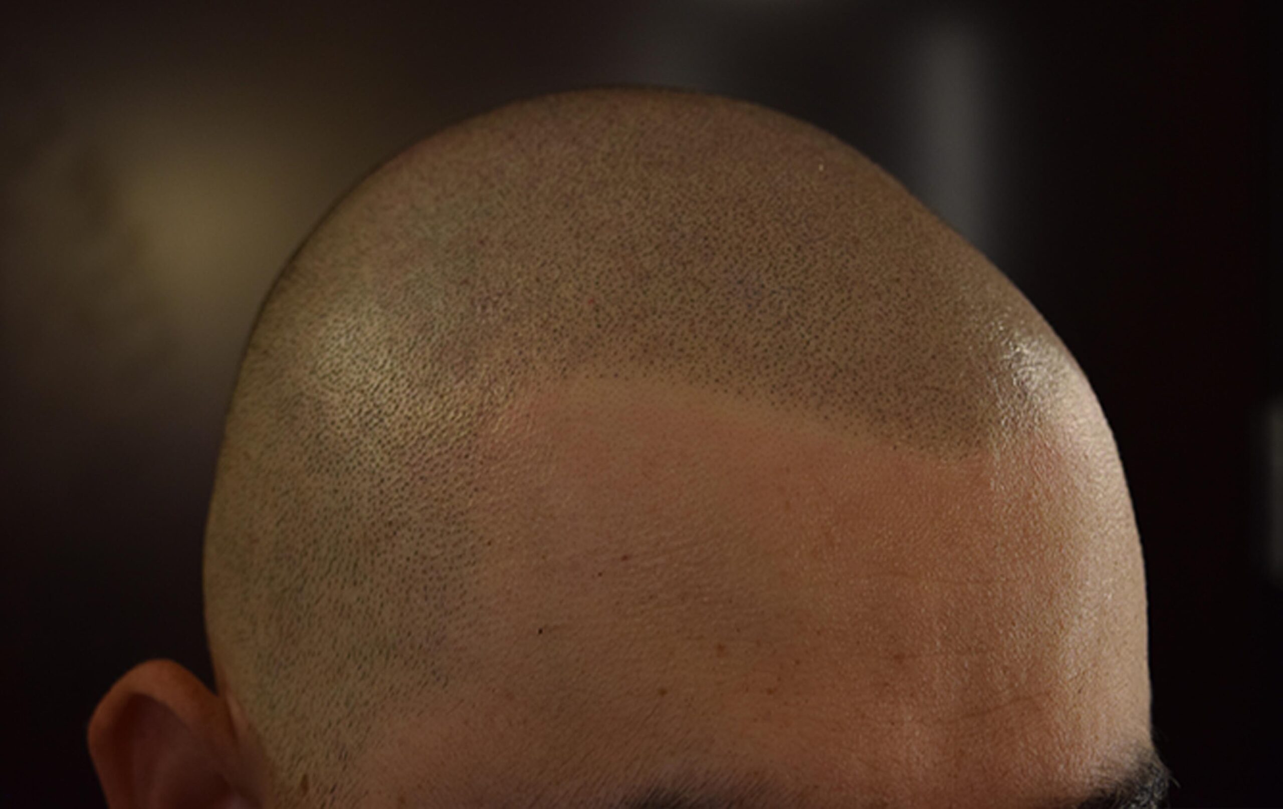 scalp micropigmentation SMP Arizona experts