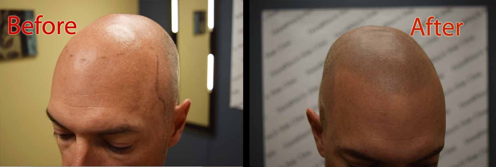 scalp micropigmentation SMP Arizona