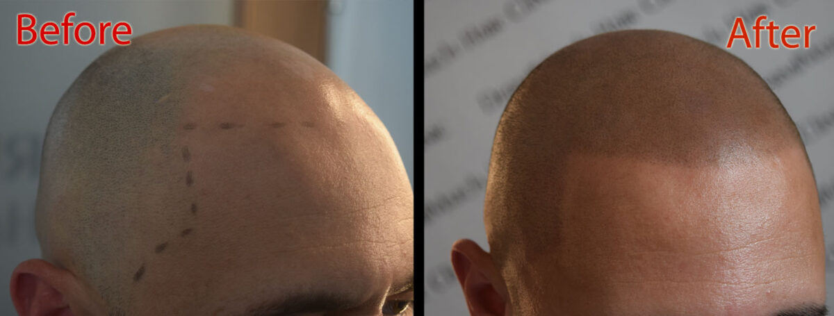 scalp micropigmentation smp arizona