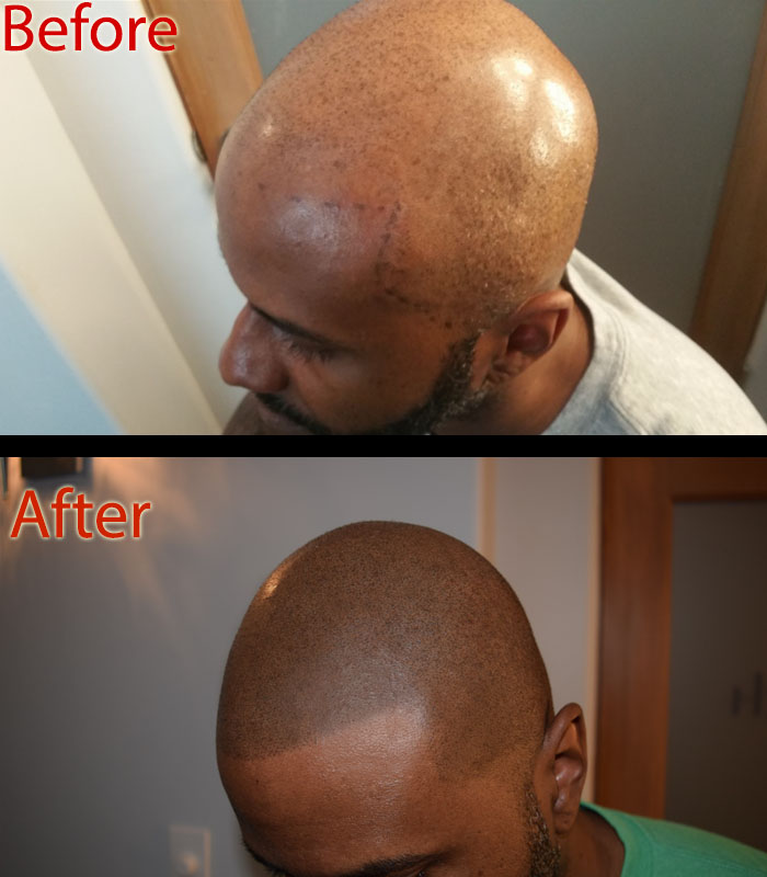 scalp micropigmentation smp arizona