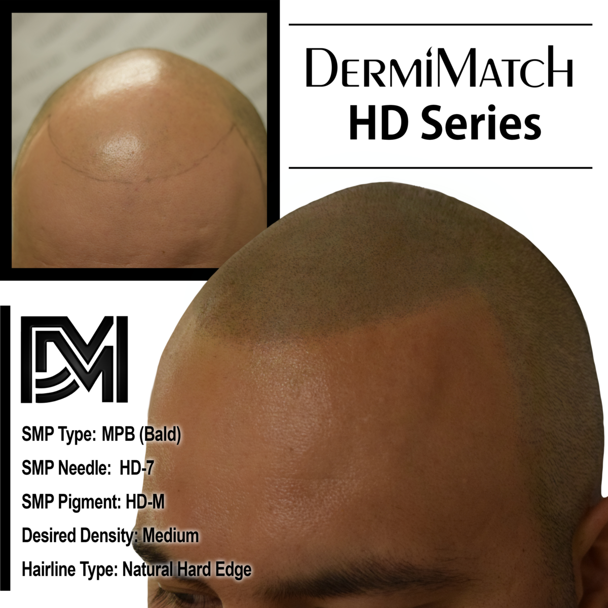 scalp micropigmentation SMP Arizona