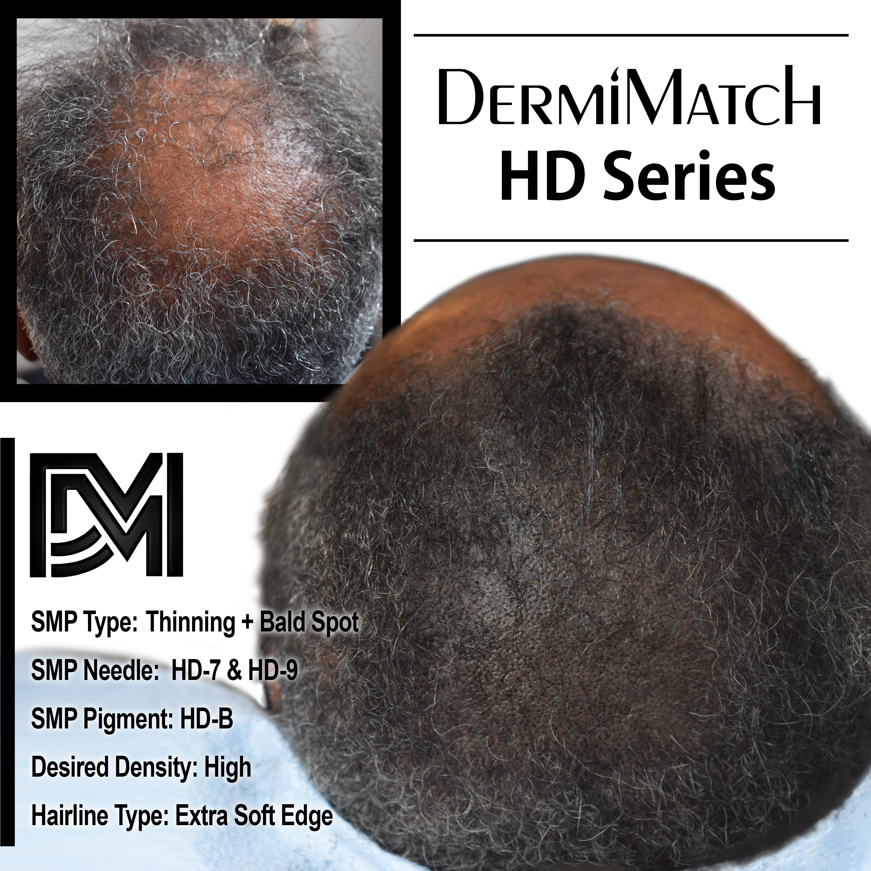 scalp micropigmentation SMP Arizona