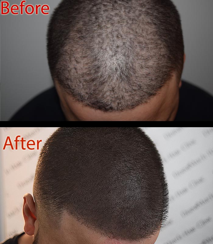 scalp micropigmentation smp in arizona for hair loss