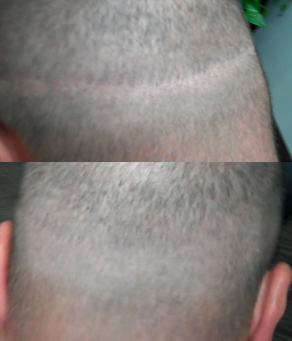 arizona scalp micropigmentation smp