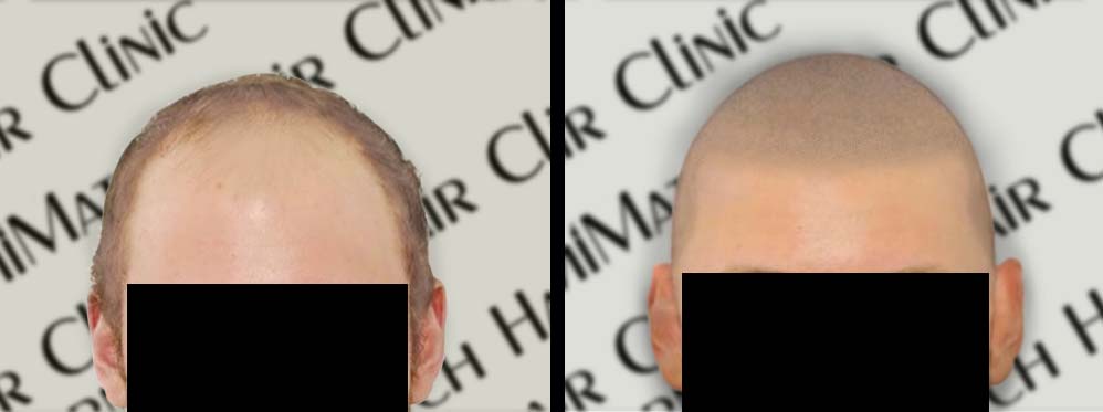 scalp micropigmentation smp versus laser hair therapy