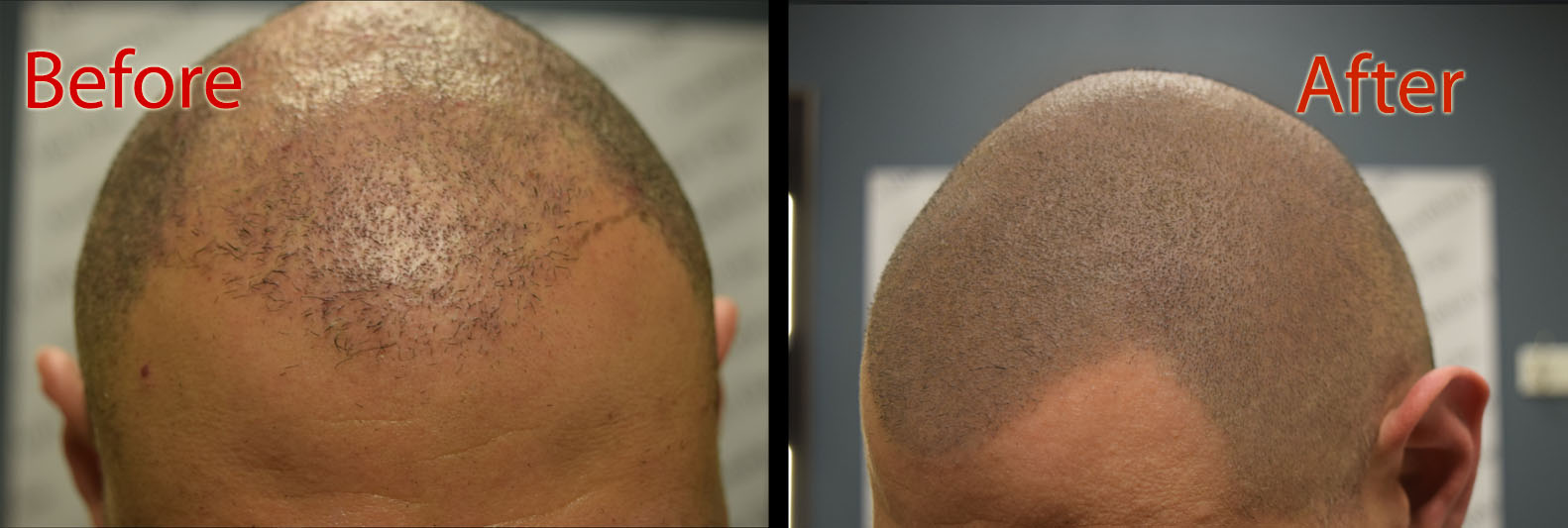 scalp micropigmentation SMP Arizona better than saw palmetto