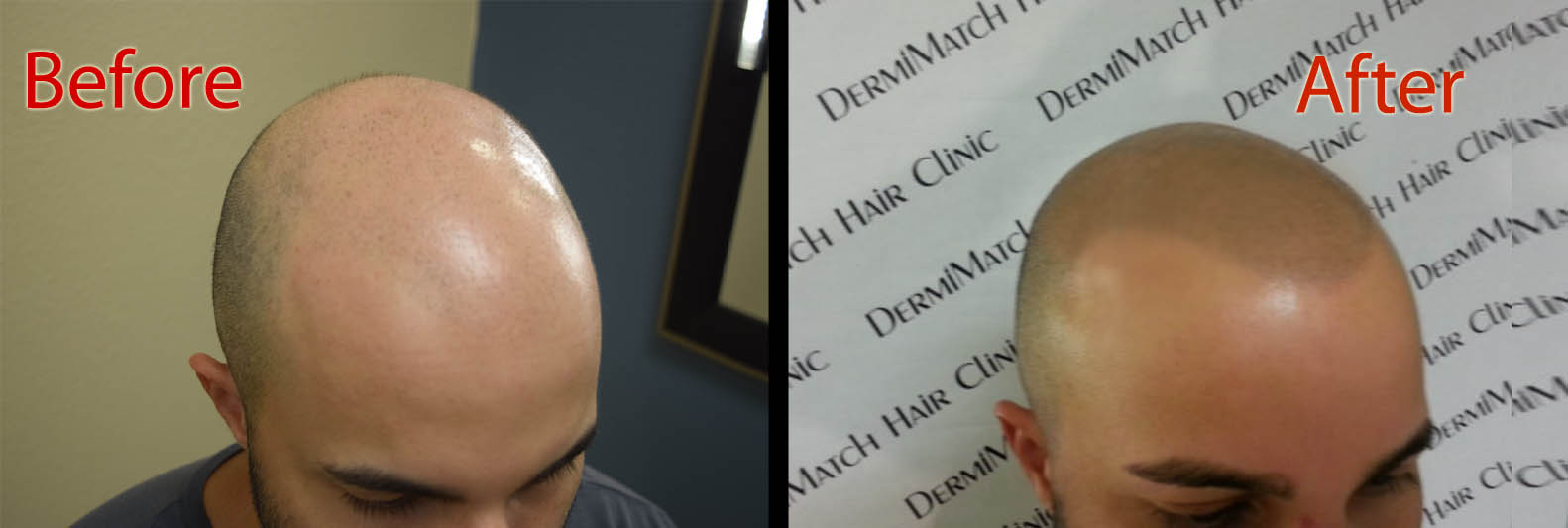 scalp micropigmentation smp arizona