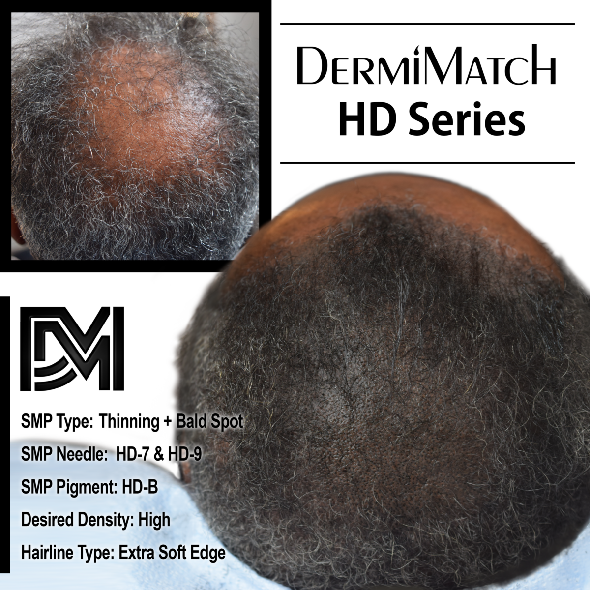 scalp micropigmentation SMP treatment in arizona