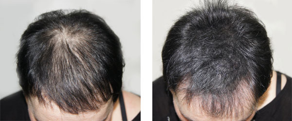 scalp micropigmentation SMP Arizona