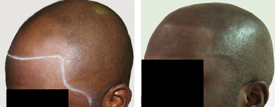 scalp micropigmentation smp arizona for genetic hair loss