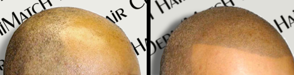 scalp micropigmentation smp arizona for hair loss