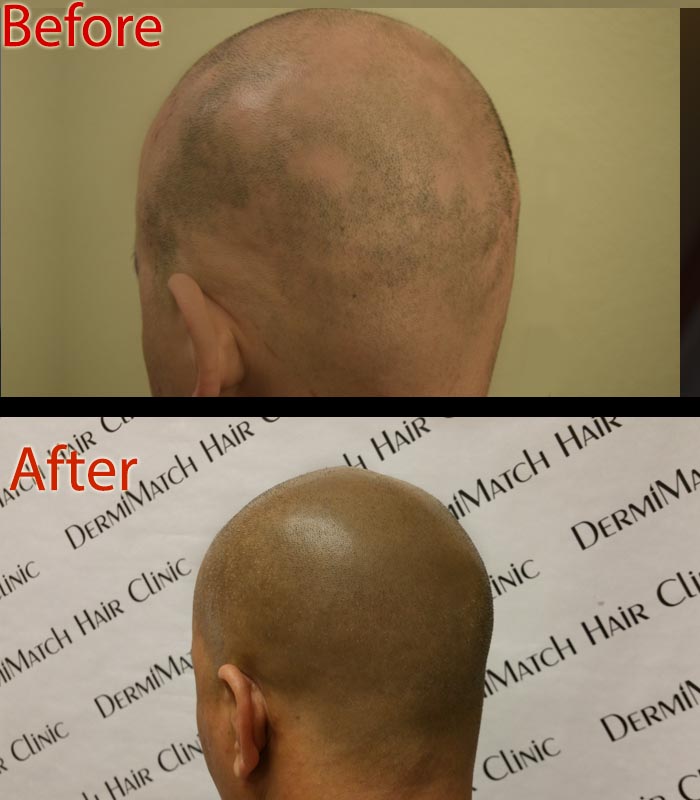 does scalp micropigmentation smp in arizona help