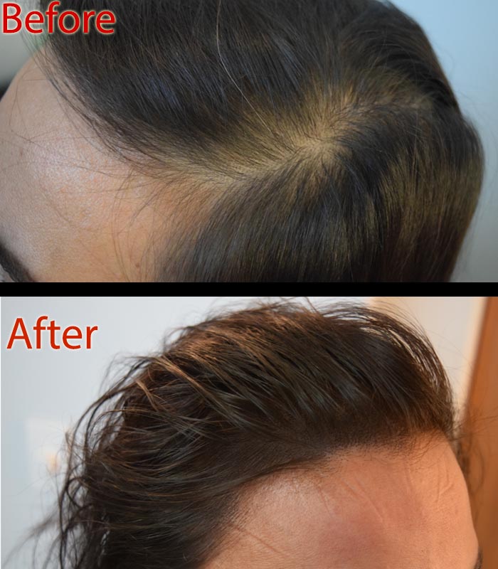 scalp micropigmentation smp arizona for hair loss in women