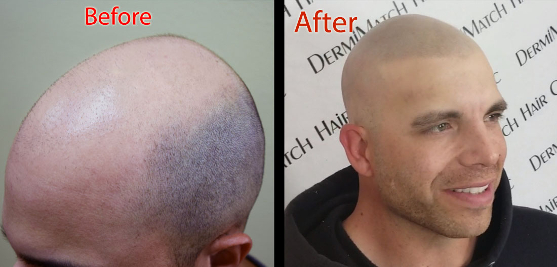 scalp micropigmentation smp arizona for hair loss