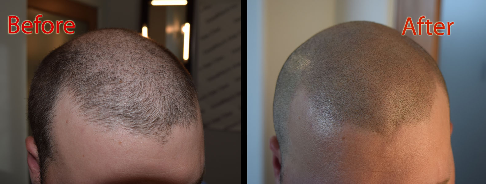 scalp micropigmentation smp for seasonal hair loss