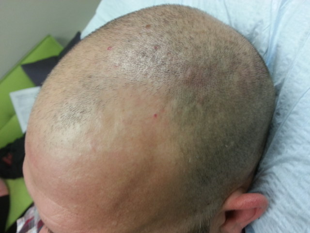 scalp micropigmentation smp arizona