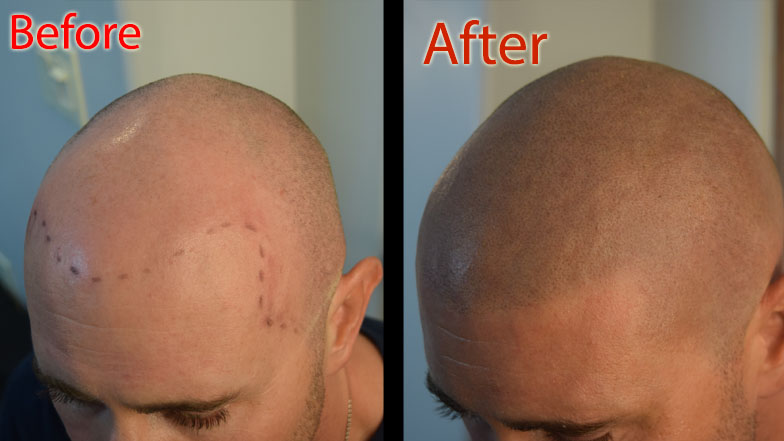 scalp micropigmentation smp for hereditary baldness in arizona