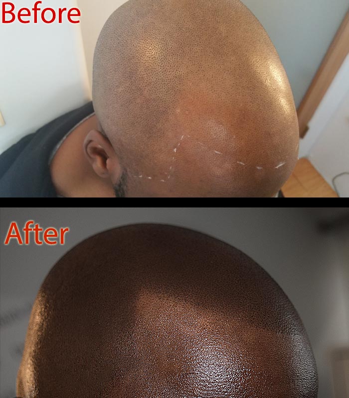 arizona scalp micropigmentation smp versus moringa