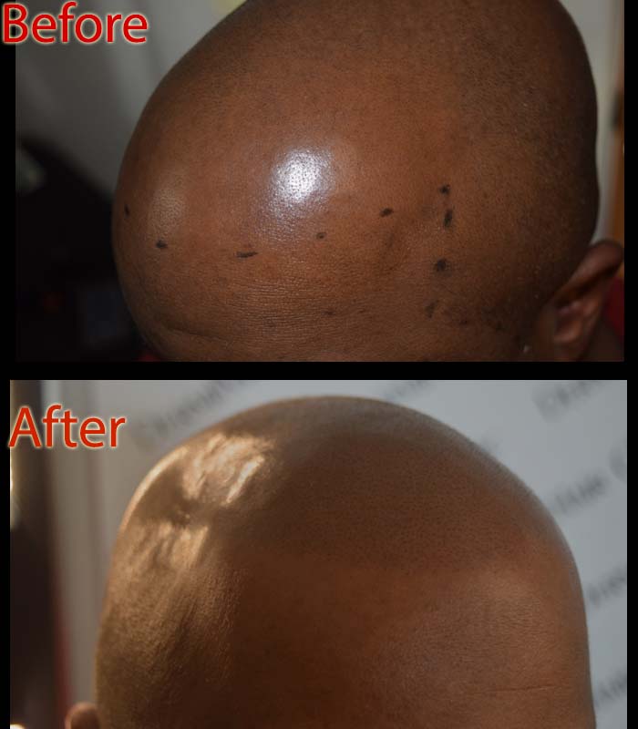 scalp micropigmentation smp arizona versus rosemary oil for hair loss