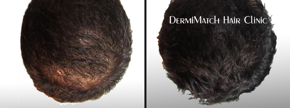 scalp micropigmentation smp arizona as hair loss therapy