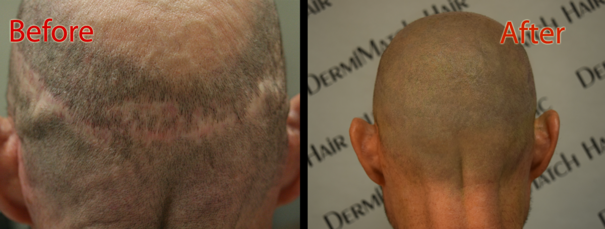 scalp micropigmentation smp arizona for hormonal hair loss