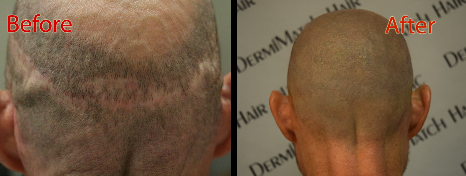 scalp micropigmentation smp arizona for hormonal hair loss