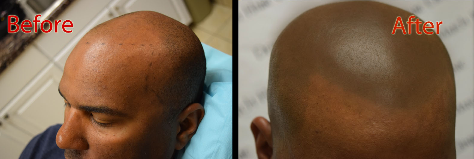 scalp micropigmentation smp arizona for hair loss