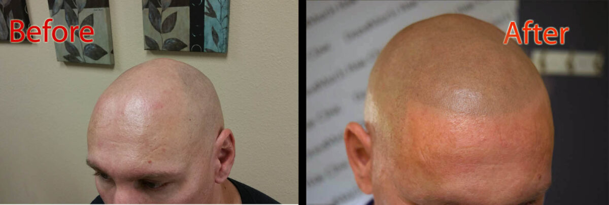 scalp micropigmentation smp arizona for pattern baldness